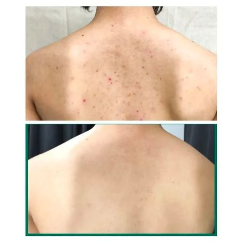 AHA BHA PHA 30 Days Miracle Acne Clear Body Cleanser - SOME BY MI