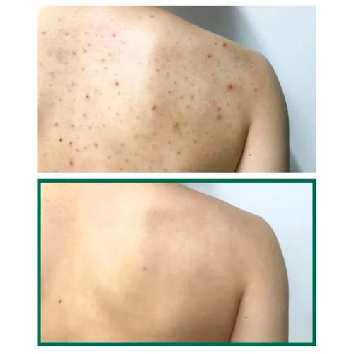 AHA BHA PHA 30 Days Miracle Acne Clear Body Cleanser - SOME BY MI